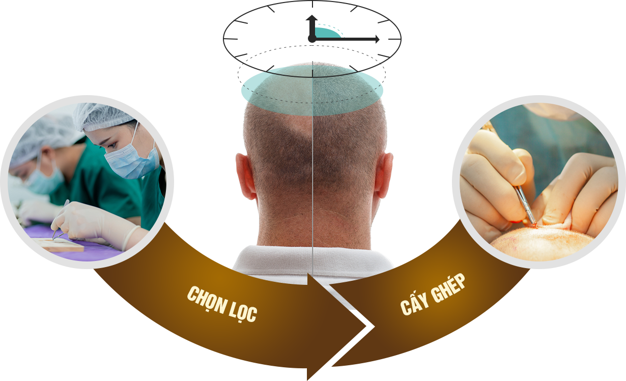 Hồi xuân với mái tóc cấy tự thân