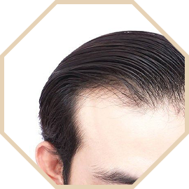 cấy tóc