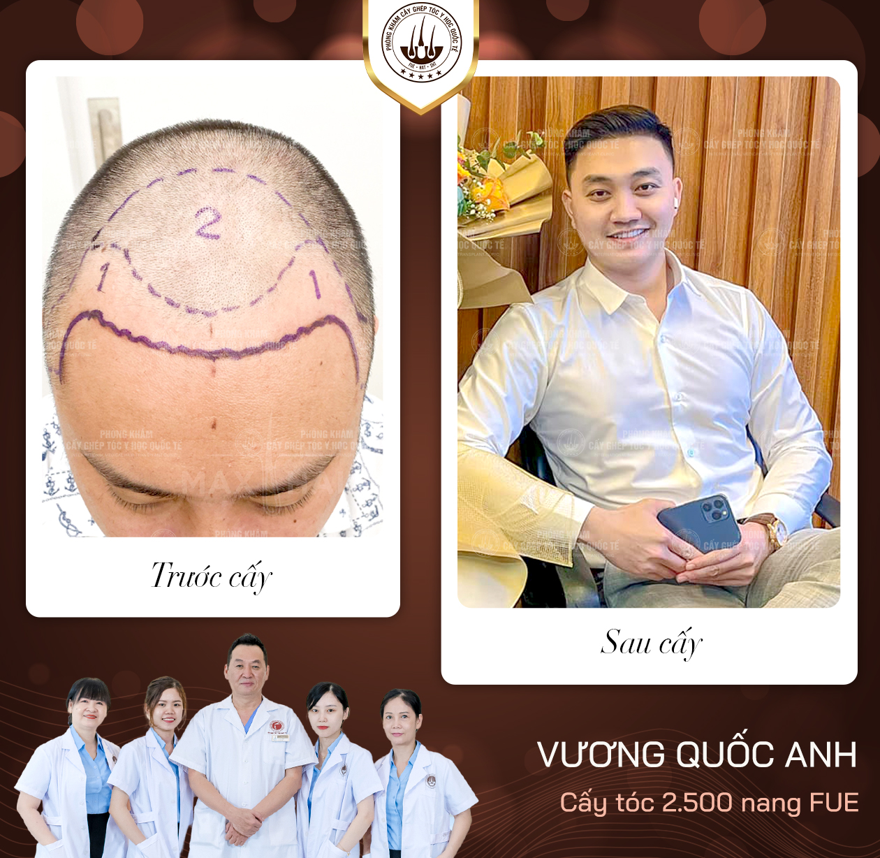 cấy lông body