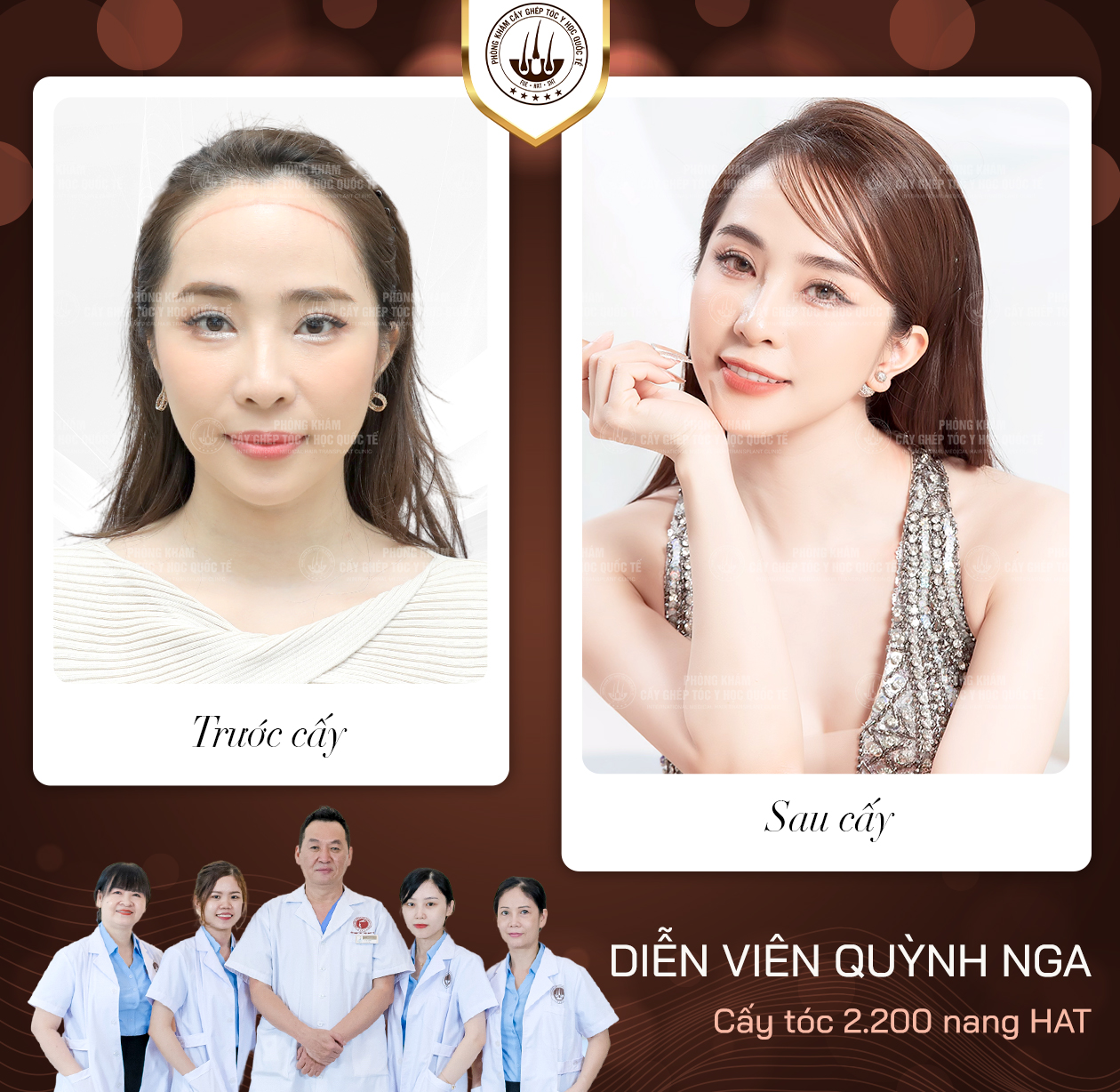 cấy lông body