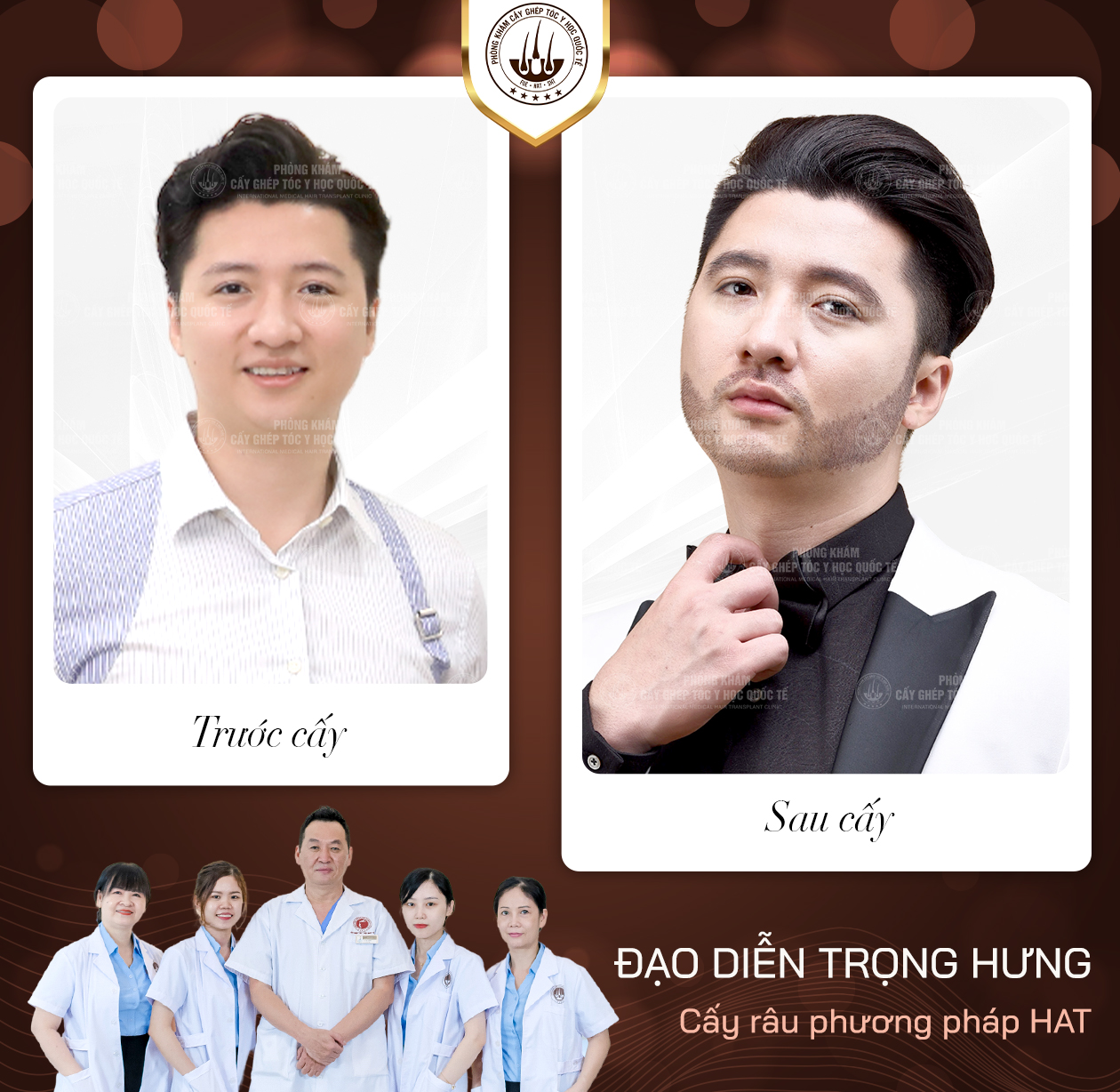 cấy lông body