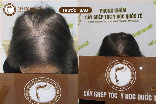 Hình ảnh trước và sau cấy tóc tự thân 6 tháng Hình ảnh trước và sau cấy tóc tự thân 6 tháng