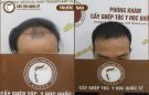 Hạ đường chân tóc là gì? Hạ bằng cách nào?