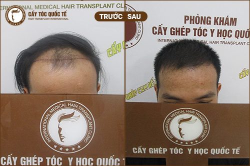 Hình Ảnh Trước Và Sau Khi Hạ Đường Chân Tóc Được 6 Tháng Hình Ảnh Trước Và Sau Khi Hạ Đường Chân Tóc Được 6 Tháng