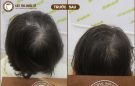 Cách trị hói đỉnh đầu ở nữ dứt điểm,triệt để