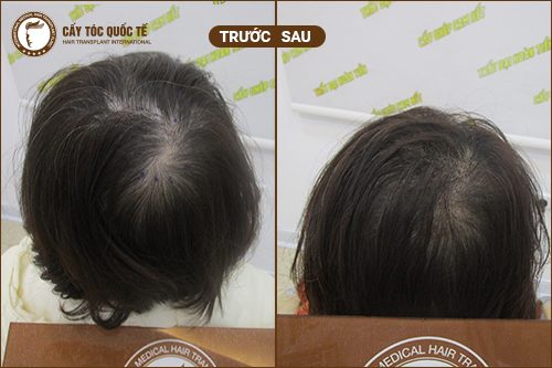 Hình ảnh trước và sau 3 tháng khi áp dụng phương pháp cấy tóc tự thân Hình ảnh trước và sau 3 tháng khi áp dụng phương pháp cấy tóc tự thân