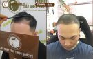Giải đáp: Cấy tóc có được vĩnh viễn không?