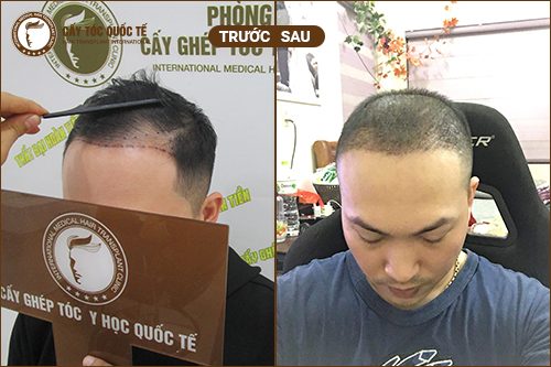 Hình Ảnh Cấy Tóc Tự Thân Trước Và Sau Khi Cấy Được 6 Tháng Hình Ảnh Cấy Tóc Tự Thân Trước Và Sau Khi Cấy Được 6 Tháng