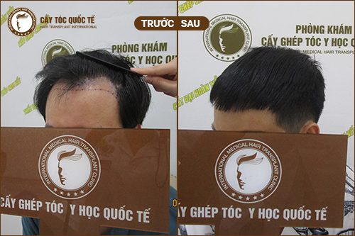 Hiệu quả cấy tóc tự thân sau 06 tháng Hiệu quả cấy tóc tự thân sau 06 tháng