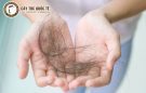 Rụng tóc nhiều, phải làm sao bây giờ?