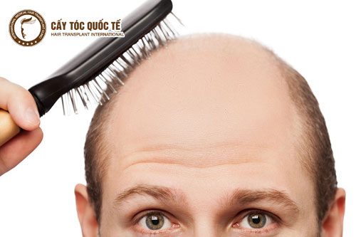 Hình ảnh rụng tóc hình chữ U khiến trán nhìn trơ chịu 
