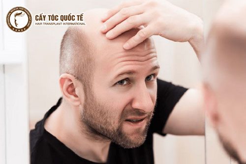 Hói đầu di truyền thường ở nam giới