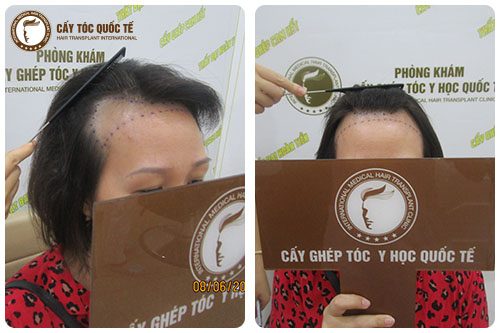 Cấy tóc là cách trị hói đầu ở nữ an toàn và hiệu quả nhất hiện nay Cấy tóc là cách trị hói đầu ở nữ an toàn và hiệu quả nhất hiện nay