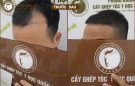 Những điều cần biết về công nghệ cấy tóc Hàn Quốc