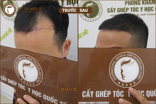 Hình ảnh trước và sau khi thực hiện phương pháp cấy tóc hàn quốc được 6 tháng Hình ảnh trước và sau khi thực hiện phương pháp cấy tóc hàn quốc được 6 tháng
