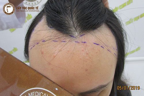 Nguyên nhân và cách khắc phục Hói Chữ M ?