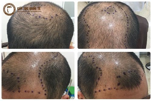 Hói đầu di truyền là phương thức dễ dẫn đến hói đầu khi tuổi đời còn rất nhỏ Hói đầu di truyền là phương thức dễ dẫn đến hói đầu khi tuổi đời còn rất nhỏ