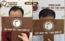 Có nên trị hói trán cho nam giới bằng cấy tóc tự thân?