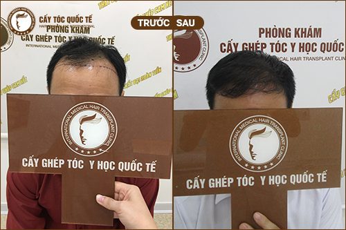 Hỉnh ảnh trước và sau khi cấy tóc tự thân trị hói trán cho nam giới sau 6 tháng Hỉnh ảnh trước và sau khi cấy tóc tự thân trị hói trán cho nam giới sau 6 tháng