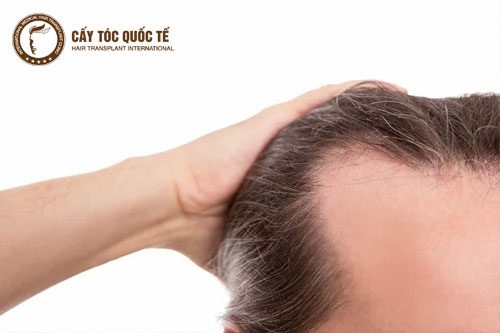 Dấu hiệu hói tóc trước trán ở nam giới Dấu hiệu hói tóc trước trán ở nam giới