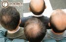 Cách trị hói di truyền hiệu quả nhất hiện nay?