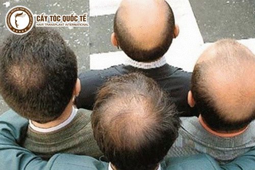 Hói đầu và đâu là cách trị hói di truyền hiệu quả?