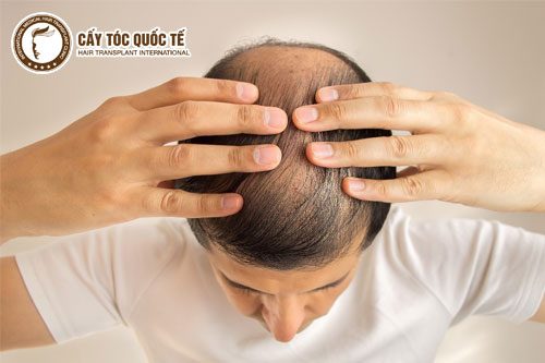 Cận thận dùng thuốc với các vùng rụng quá 6 tháng. Cận thận dùng thuốc với các vùng rụng quá 6 tháng.