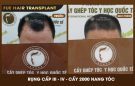 Cấy tóc nam giới và những điều cần biết