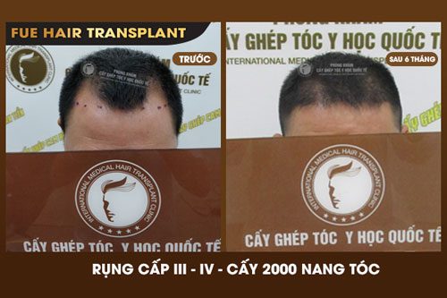 Hình Ảnh Trước Và Sau Khi Cấy 2000 Nang Tóc Được 6 Tháng 