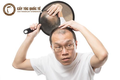 Hói đầu – Điều gì khiến nam giới lo sợ?