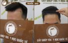 Nam giới bị hói di truyền có chữa được không?