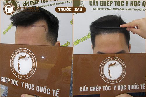Hình Ảnh Cấy Tóc Chữ M Trước Và Sau 6 tháng Hình Ảnh Cấy Tóc Chữ M Trước Và Sau 6 tháng