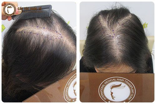 Hói đỉnh đầu nữ khiến mất tự tin cho phái đẹp Hói đỉnh đầu nữ khiến mất tự tin cho phái đẹp