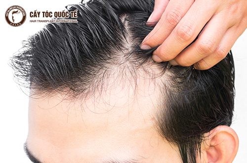 Chữa hói 2 bên trán ở nam giới hiệu quả