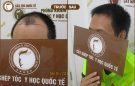 Có nên cấy tóc tự thân không? Giải đáp từ chuyên gia