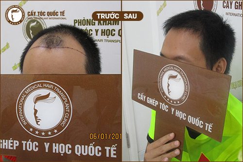 Có nên cấy tóc tự thân không? Giải đáp từ chuyên gia