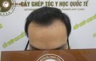Cách trị hói trán nào hiệu quả nhất hiện nay?
