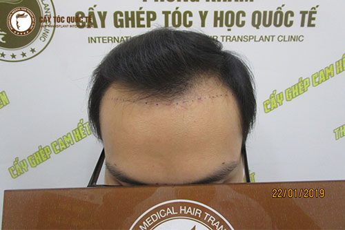 Hói trán hình chữ M Hói trán hình chữ M