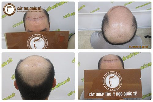 Hói đầu hình chữ U khiếm kém thẩm mỹ cho người bị bệnh 