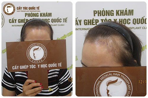 Cách chưa hói trán bằng phương pháp cấy tóc tự thân Cách chưa hói trán bằng phương pháp cấy tóc tự thân