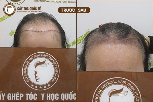 Phương pháp cấy tóc nữ giới  có điểm gì đặc biệt?
