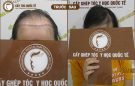 Trán cao bẩm sinh – Nỗi khổ của nàng trán “sân bay”