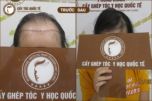 Cấy tóc tự thân cho người trán cao là hiệu quả và an toàn nhất Cấy tóc tự thân cho người trán cao là hiệu quả và an toàn nhất