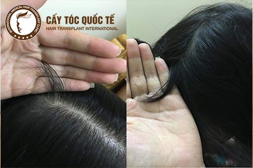 Mọc tóc con khi sử dụng thuộc Biotin Mọc tóc con khi sử dụng thuộc Biotin