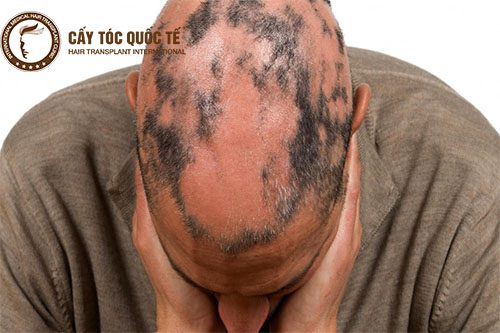 Dấu hiệu hói tóc từng mảng 