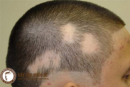 Dấu hiệu hói đầu bệnh lý lốn đốm từng mảng trên đầu Dấu hiệu hói đầu bệnh lý lốn đốm từng mảng trên đầu
