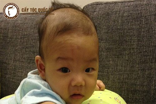 Hói đầu bẩm sinh ngay khi sơ sinh đã bị hói Hói đầu bẩm sinh ngay khi sơ sinh đã bị hói