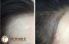 Hói bẩm sinh và cách đối phó hiệu quả