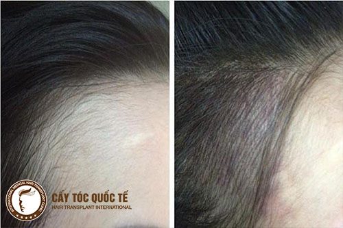 Phun xăm chân tóc che lấp khuyết điểm đáng kể Phun xăm chân tóc che lấp khuyết điểm đáng kể