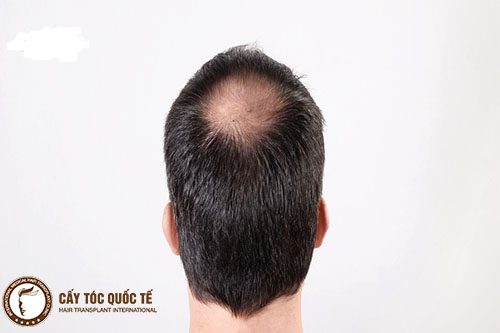 Hình ảnh 1 người bị hói đỉnh đầu Hình ảnh 1 người bị hói đỉnh đầu